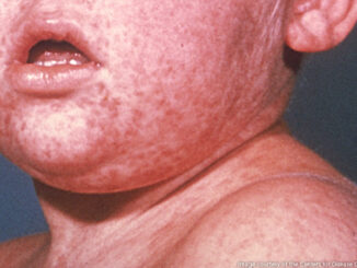 Face of boy with measles; third day of rash. Photo: Image courtesy of the Centers for Disease Control and Prevention/Barbara Rice.