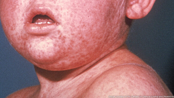 012915_03P_FS Face of boy with measles; third day of rash. Photo: Image courtesy of the Centers for Disease Control and Prevention/Barbara Rice.