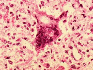 Measles under microscope