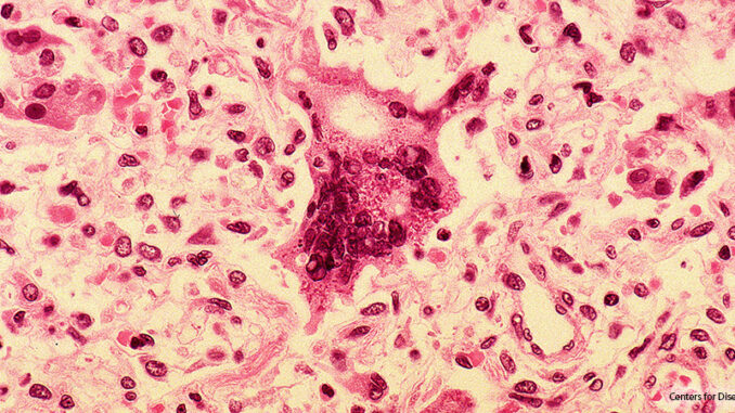 021119_02P_FS Measles under microscope