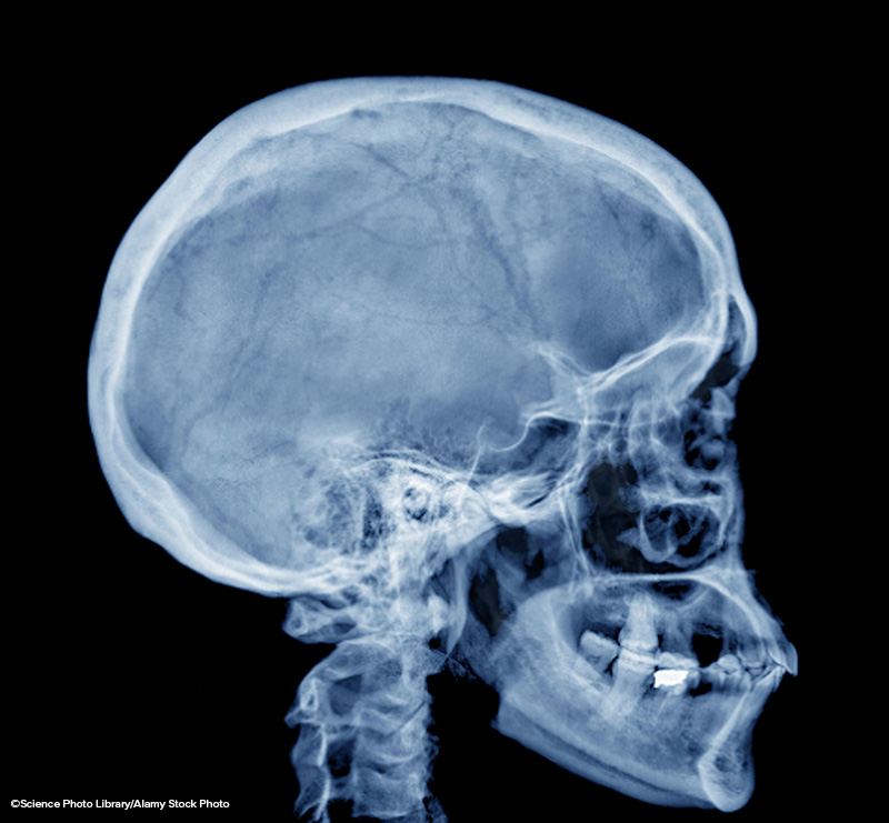 Side view of a normal skull with colored X-ray